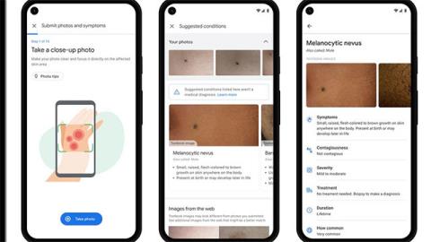 Google ontwikkelt AI-algoritmen die dermatologische ziekten en tuberculose kunnen diagnosticeren